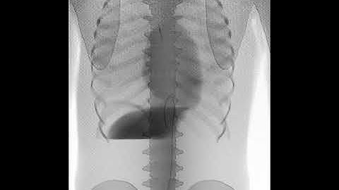 The super stiff guide wire physical simulation