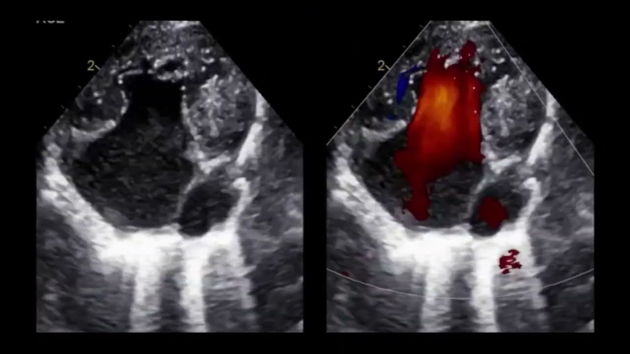 30 findings from Echo Apical views