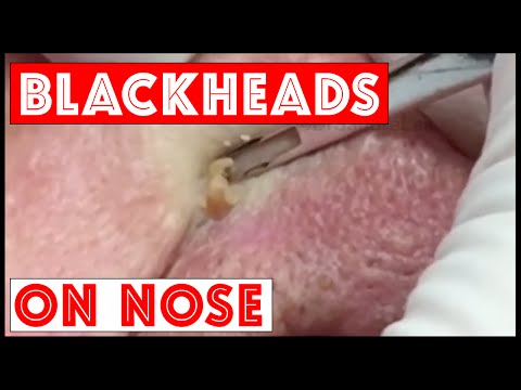 Blackheads, TNTC: Session 2My patient who lost his wife. For medical education- NSFE. - Blackheads, TNTC: Session 2My patient who lost his wife. For medical education- NSFE.
