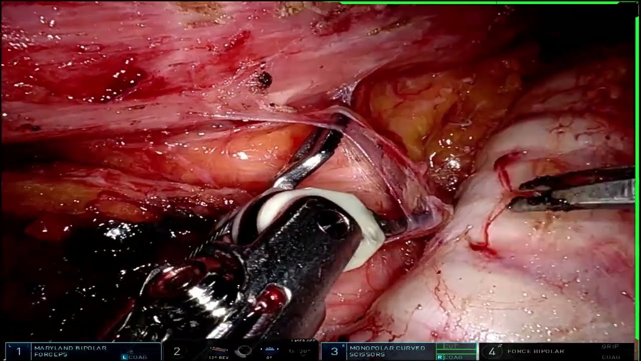 Dissection along the left recurrent laryngeal nerve in robotic esophagectomy.