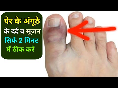 पैर के अंगूठे में दर्द व सूजन का इलाज | Pair ke anguthe me dard ka ilaj |