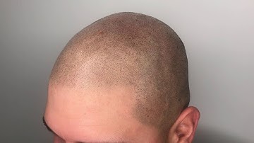 Scalp Micropigmentation after laser tattoo removal