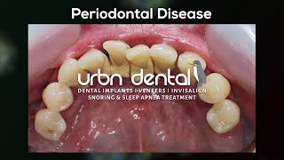 Understanding Periodontal Disease and Bone Loss: Causes, Symptoms, and Treatment Options