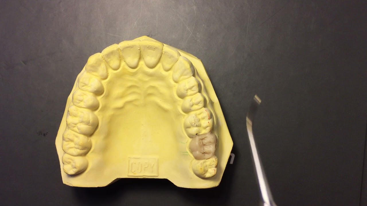 Segundo molar superior, forma romboidal - YouTube