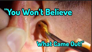 Extreme Earwax Removal | Deep Ear Cleaning with Satisfaction Sounds 😌👂 | ASMR Ear Care