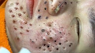 Loan Nguyen Acne Treatment 14066