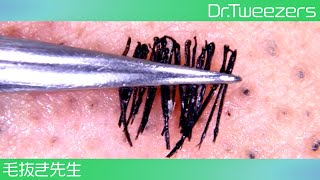 Pull out a number of beards 毛抜き先生の角栓や毛根