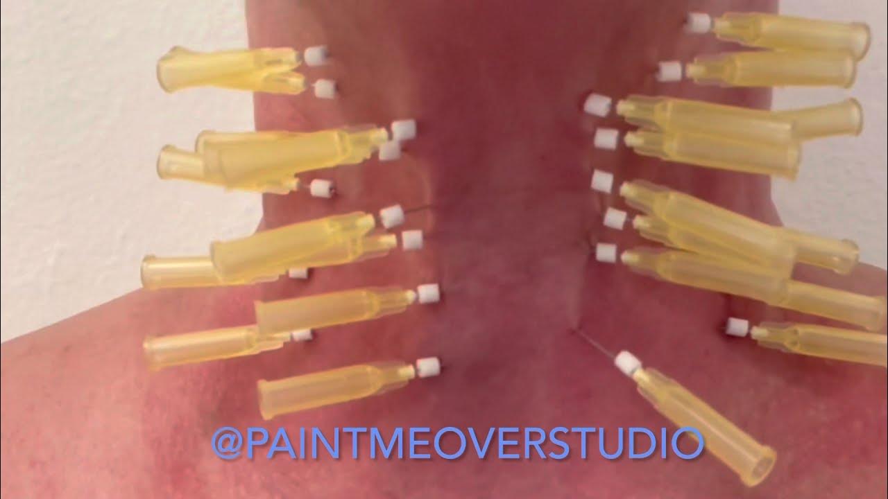 💙 PDO THREADS NECKLIFT BRUISING. YouTube