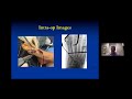 LapiFuse™: Finding a Better Way to Bunion Correction with Dr. Jeremy McCormick