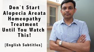 Don't Start Alopecia Areata Homeopathy Treatment Until You Watch This! including Home Remedies