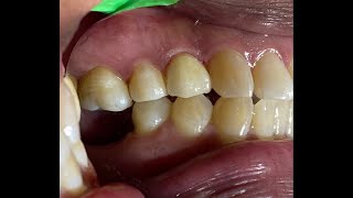 Como reconstruir un DIENTE CON ENDODONCIA