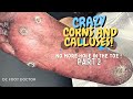 No More Hole In The Toe, Part 2: Trimming Crazy Corns and Calluses