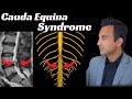 Ref:0SNfBFuLGcI Cauda equina syndrome