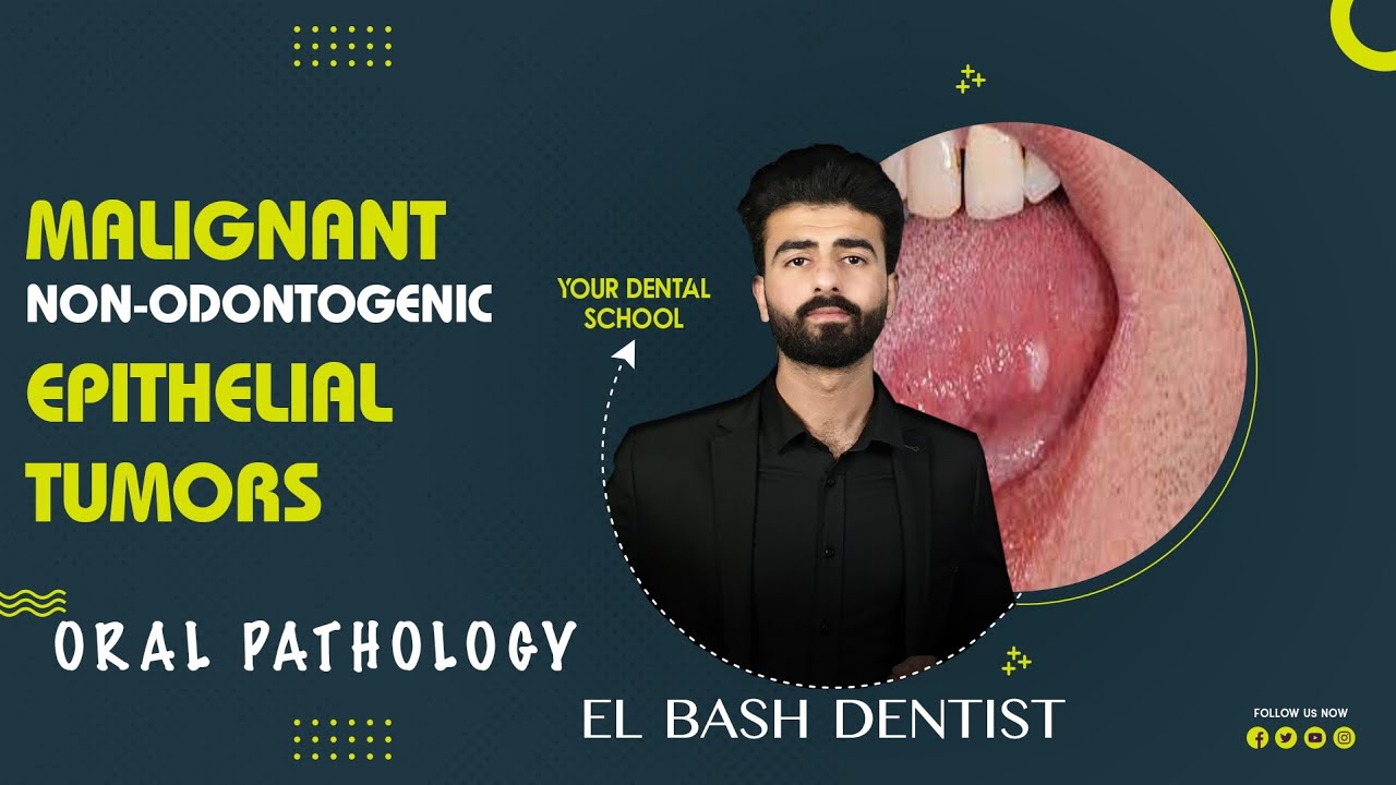 squamous cell carcinoma || oral pathology || عزت شومان