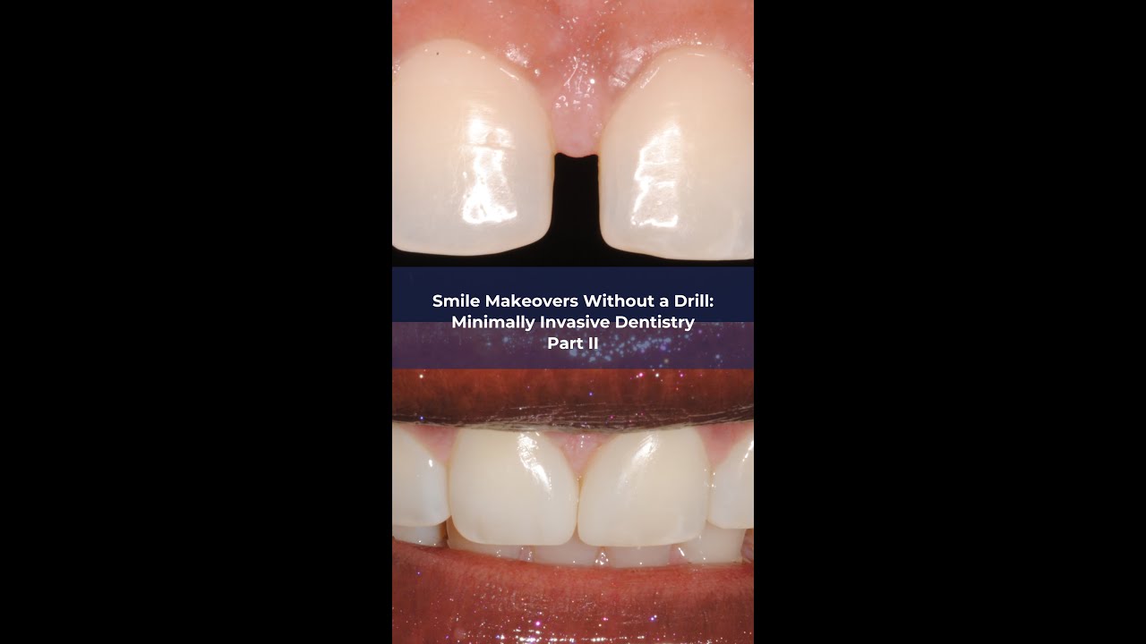 Smile Makeovers Without the Drill: Minimally Invasive Dentistry. Part 2