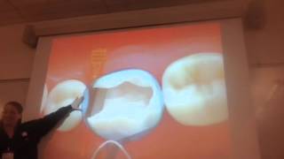 Pinch dental composite matrix