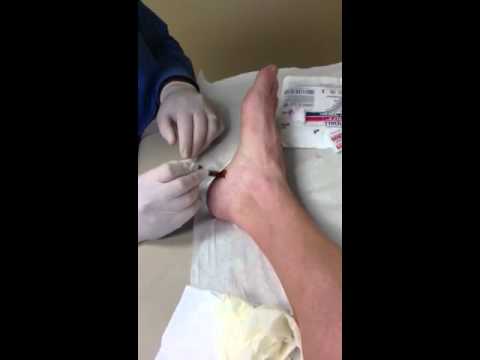 Steroid injection in foot recovery