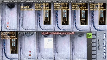 The easiest way to remove nonvisible broken files/最も簡単に見えない破折器具を除去する方法