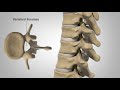 Myelopathy - Patient Education