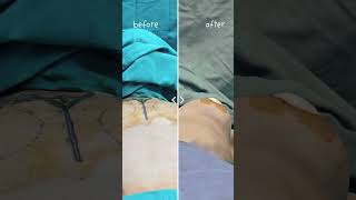 Breast implant surgery sirf size increase karne ke baare mein nahi hai #breastsurgeon #breastimplant