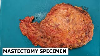 Radical mastectomy specimen