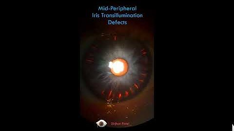 Mid-peripheral Iris Transillumination Defects - see on Retroillumination