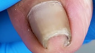 Amazing Ingrown nails extremely curly【Xue Yidao】