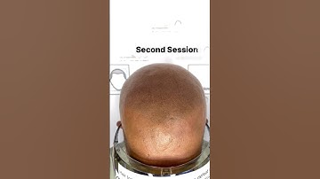 Second session of SMP ❤️#scalpmicropigmentationbangalore #hairlosssolution #hairtattoobangalore