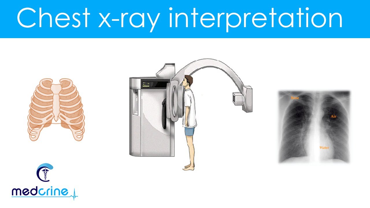 Basic Skills For Chest X Ray Interpretation Youtube