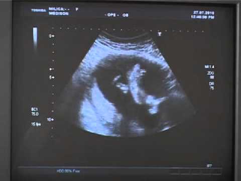 Video: Mogu li 3 crtice na ultrazvuku značiti dječaka?