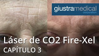 Láser de CO2 Fire-Xel - Capítulo 3 (21042)