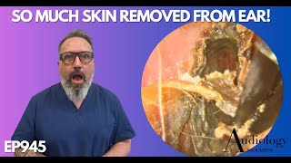 So Much Skin Removed From Patients Ear Canal - Ep945