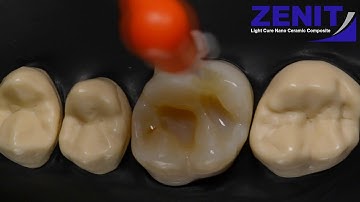 Occlusal stamp technique !