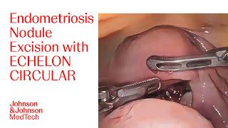 Large Rectal and Sigmoid Endometriosis Nodule Removal Procedure with ECHELON CIRCULAR | J&J MedTech