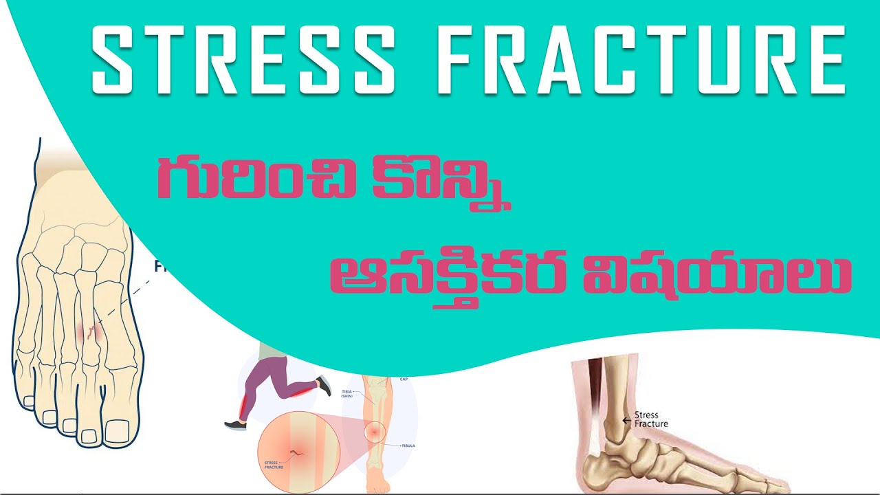 Interesting facts about stress fracture health care youtube