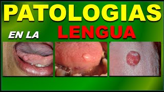 BENIGN LINGUAL PATHOLOGY IN ADULTS