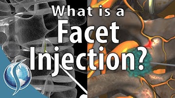 What is a Facet Injection?