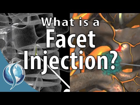 What is a Facet Injection?