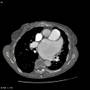 Radiology Rounds @ radRounds.com: CT scan of the chest demonstrating extremely enlarged left atrium