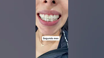 ¿Debo cambiar mi Invisalign por la mañana o por la noche?