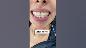 ¿Qué ocurre si me salto Invisalign durante un día?