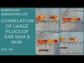 COMPILATION OF LARGE PLUGS OF EAR WAX & SKIN - EP161