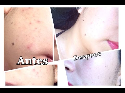 Crema Tia Mana,Como quitar Acne,crema curativa y limpiadora Efectiva....mi experiencia