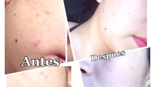 Crema Tia Mana,Como quitar Acne,crema curativa y limpiadora Efectiva....mi experiencia