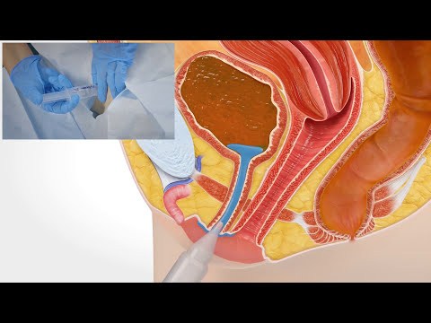 Video: 3 måder at fjerne et urinkateter på