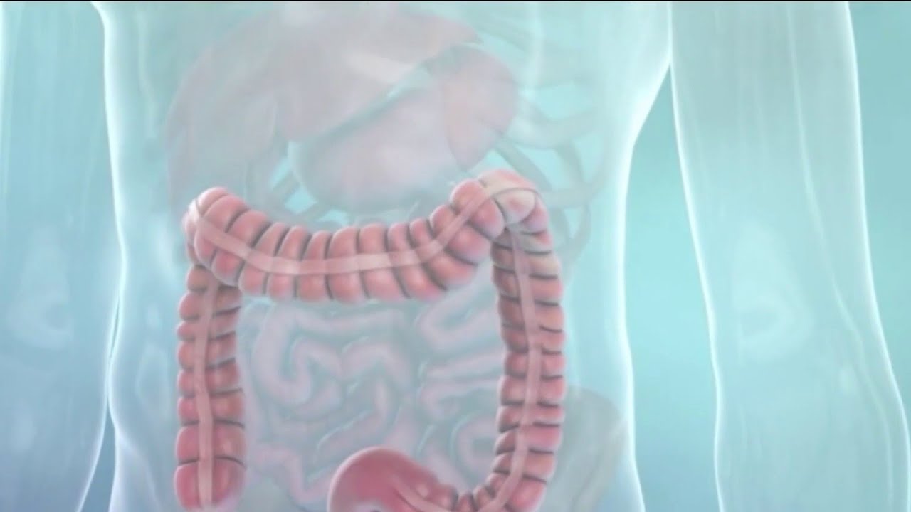 Colon cancer concerns