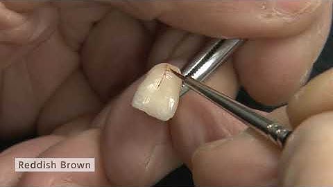 MDT. Hitoshi Aoshima using Cerabien ZR (CZR) for Build-up Technique. Part 3.