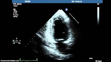 AccreditCoach Tutorial:  Image Quality   Good endocardial visualization