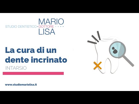 STUDIO MARIO LISA - La cura di un dente incrinato - Intarsio