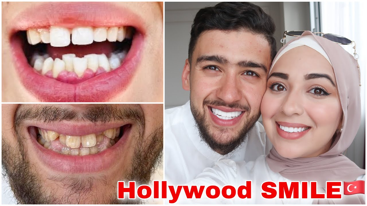عملنا Hollywood smille 😁 في تركيا 🇹🇷 | شحال الثمن €؟ واش قلعنا السنان 🦷 ؟